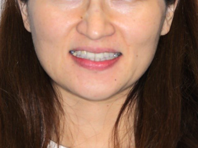 打敗牙齒亂，創造微笑曲線