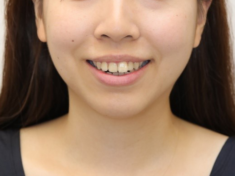 擊敗嬰兒肥，素人大變身!