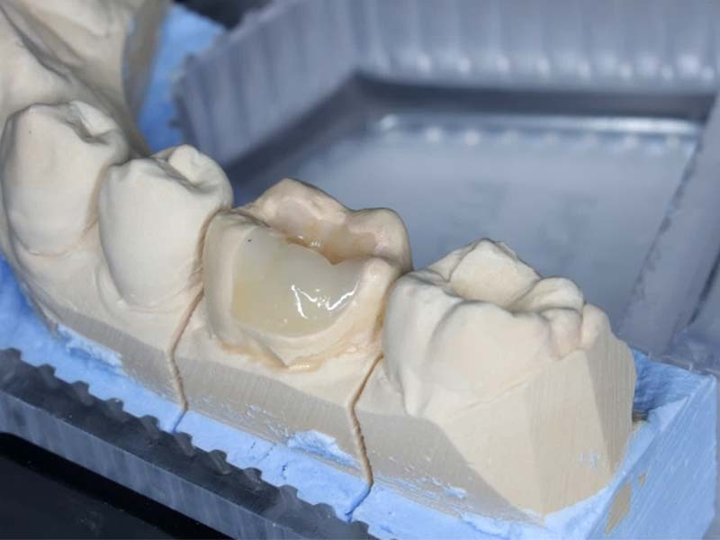 3D數位齒雕(案例2)