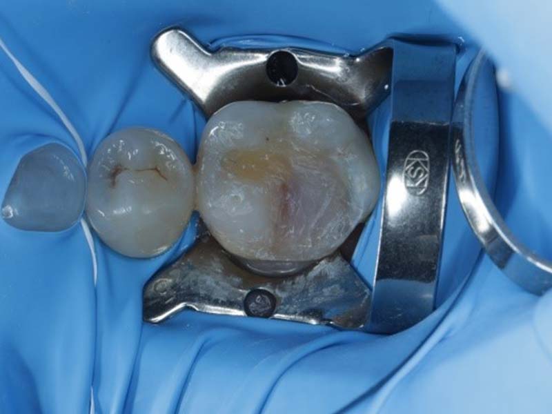 3D數位齒雕(案例1)