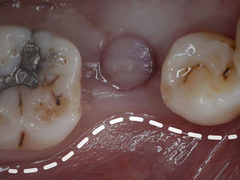 為什麼需要補骨，不能直接植牙呢？