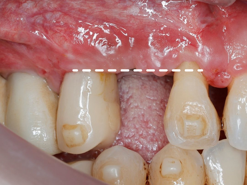 補骨不可怕，植牙失敗才可怕！