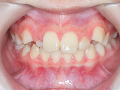 MRC訓練改善擁擠齒列｜孩子笑容的改變從呼吸開始