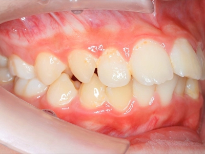 不靠鋼線，靠呼吸與肌肉訓練也能讓牙齒變整齊