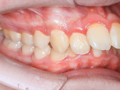 不只是變整齊，更是「從內而外」的臉型變化！隱適美反咬合矯正真實案例