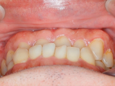 牙齒太亂？透明牙套也能讓你悄悄變美！