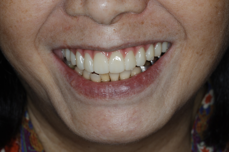 桃園全口假牙